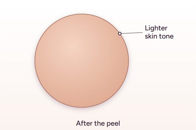 After: Intimate area lightening