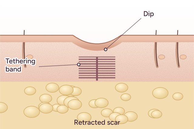 Before: Scar correction