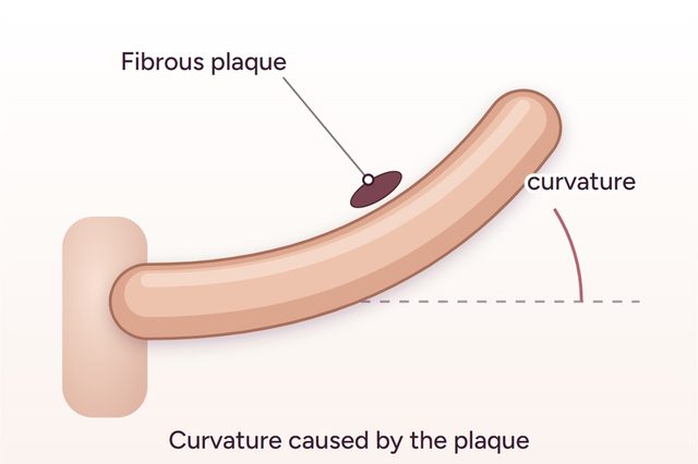 Before: Correction of penile curvature