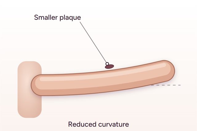 After: Correction of penile curvature