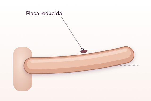 Después: Corrección de la incurvación del pene