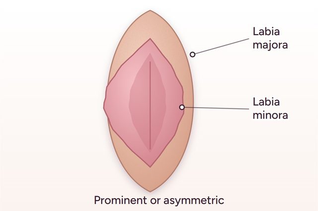 Before: Labia minora labiaplasty
