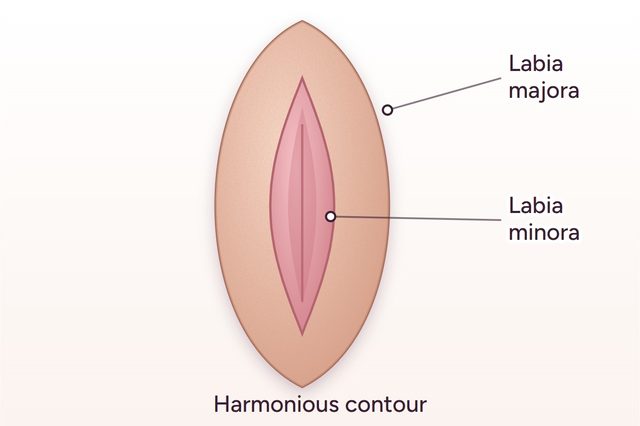 After: Labia minora labiaplasty