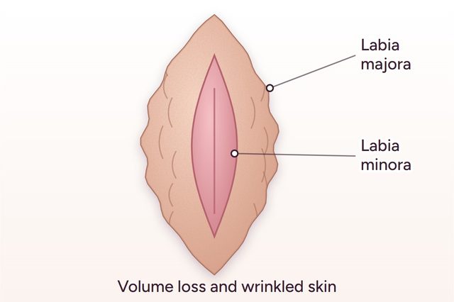 Before: Labia majora filler