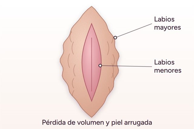 Antes: Relleno de labios mayores
