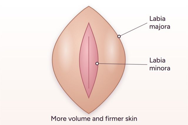After: Labia majora filler