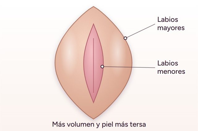 Después: Relleno de labios mayores