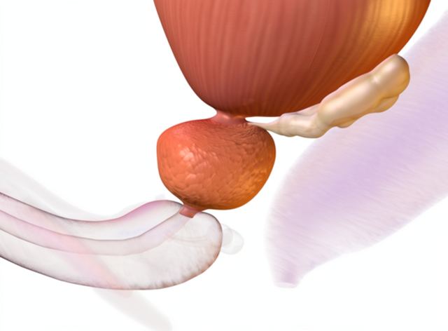 Antes: Prostatectomía radical robótica