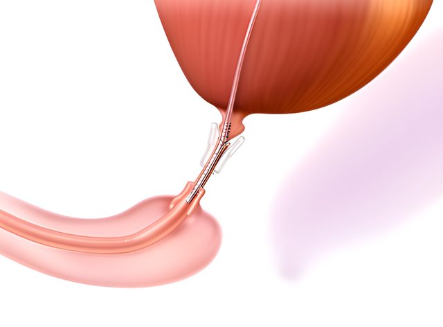 Después: Prostatectomía radical robótica